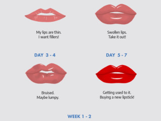 Lip Filler Journey Poster