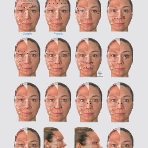 botulinum-toxin-chart-poster-big-0